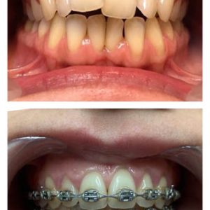 Fiksna proteza, Stomatolog Zarkovo, Lena V