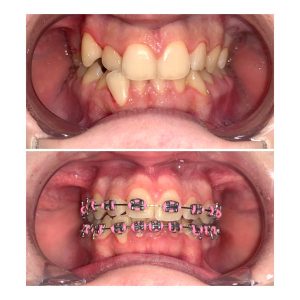 Fiksna proteza, Stomatolog Zarkovo, Lena V