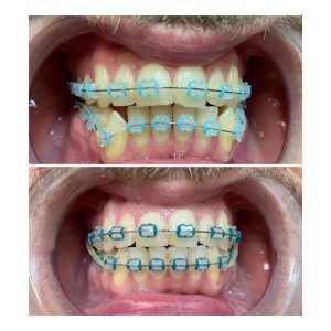 Fiksna proteza, Stomatolog Zarkovo, Lena V