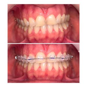 Fiksna proteza, Stomatolog Zarkovo, Lena V