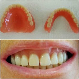 Akrilatna proteza Zubar Zarkovo Moj Stomatolog Sandra Marinkovic Visnjic Ordinacija LenaV