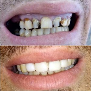 Fasete Zubar Zarkovo Moj Stomatolog Sandra Marinkovic Visnjic Ordinacija LenaV