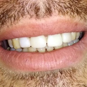 Fasete Zubar Zarkovo Moj Stomatolog Sandra Marinkovic Visnjic Ordinacija LenaV2