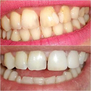 Fasete Zubar Zarkovo Moj Stomatolog Sandra Marinkovic Visnjic Ordinacija LenaV3