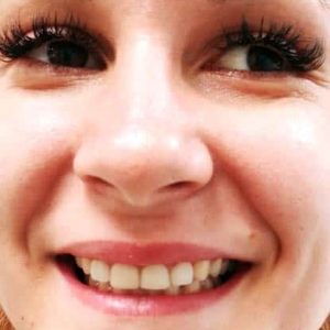 Fasete Zubar Zarkovo Moj Stomatolog Sandra Marinkovic Visnjic Ordinacija LenaV4