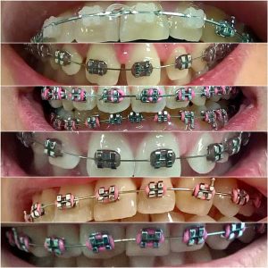 Fiksna proteza, Stomatolog Zarkovo, Lena V