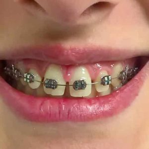 Fiksna proteza, Stomatolog Zarkovo, Lena V