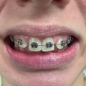 Fiksna proteza, Stomatolog Zarkovo, Lena V