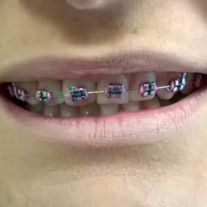 Fiksna proteza, Stomatolog Zarkovo, Lena V