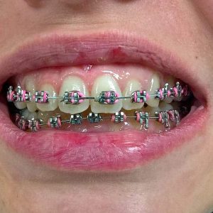 Fiksna proteza, Stomatolog Zarkovo, Lena V