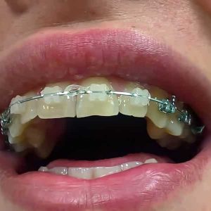 Fiksna proteza, Stomatolog Zarkovo, Lena V