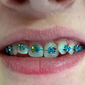 Fiksna proteza, Stomatolog Zarkovo, Lena V