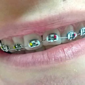 Fiksna proteza, Stomatolog Zarkovo, Lena V