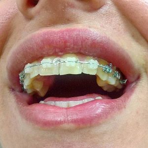 Fiksna proteza, Stomatolog Zarkovo, Lena V