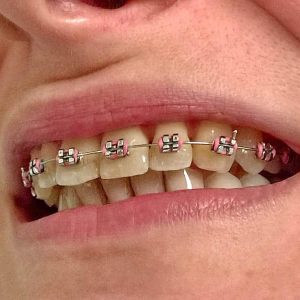 Fiksna proteza, Stomatolog Zarkovo, Lena V