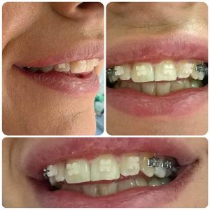 Fiksna proteza, Stomatolog Zarkovo, Lena V