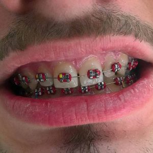 Fiksna proteza, Stomatolog Zarkovo, Lena V