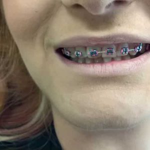 Fiksna proteza, Stomatolog Zarkovo, Lena V