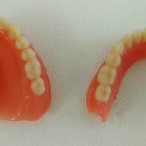 Akrilatna proteza Zubar Zarkovo Moj Stomatolog Sandra Marinkovic Visnjic Ordinacija LenaV