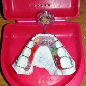 Mobilne proteze Zubar Zarkovo Moj Stomatolog Sandra Marinkovic Visnjic Ordinacija LenaV5