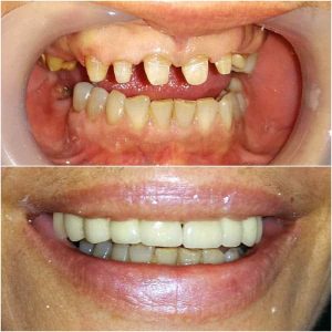 Nasi radovi Stomatolog Zarkovo - 003