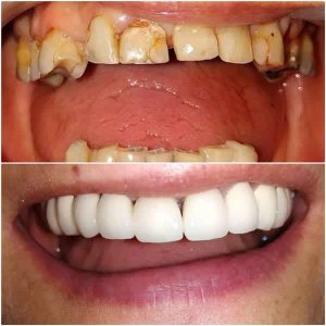 Nasi radovi Stomatolog Zarkovo - 004