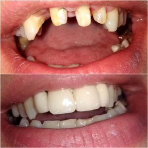 Nasi radovi Stomatolog Zarkovo - 012