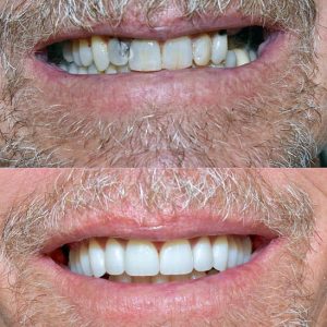 Nasi radovi Stomatolog Zarkovo - 015