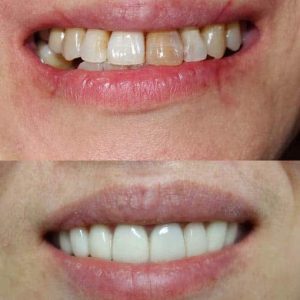 Nasi radovi Stomatolog Zarkovo - 016