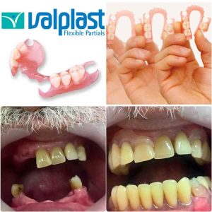 Valplast Proteza Zubar Zarkovo Moj Stomatolog Sandra Marinkovic Visnjic Ordinacija LenaV